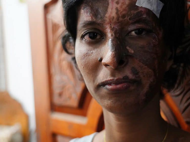 Srilankalainen naiskristitty kasvot vahingoittuneena